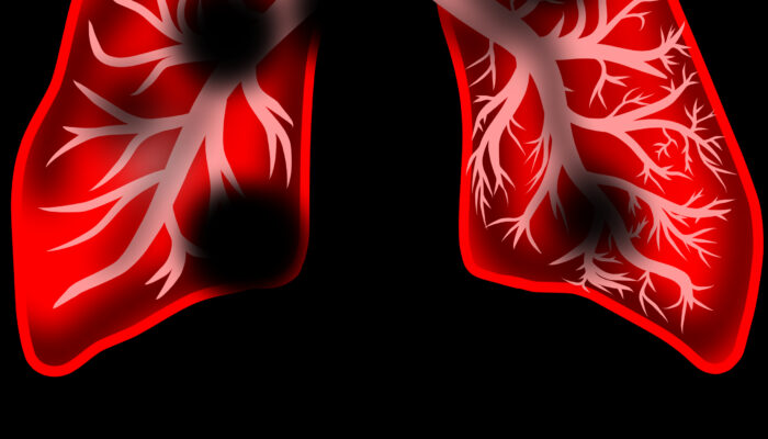 Diagnostyka i rozliczanie świadczeń dotyczących leczenia chorób płuc oraz raka płuca